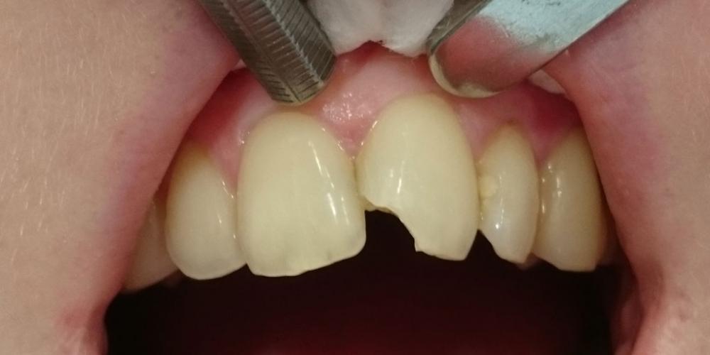 Восстановление анатомической формы 2.1 зуба материалом Estelite - фото №1