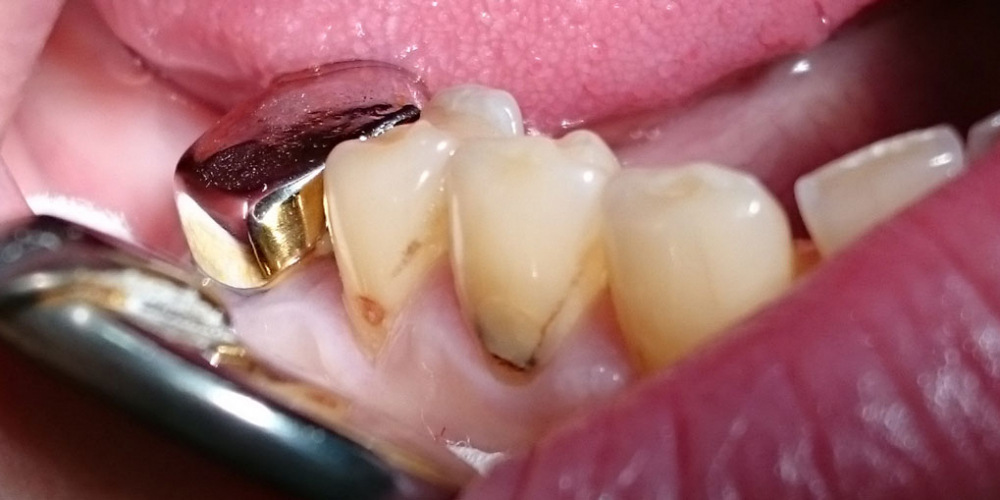 Лечение клиновидного дефекта, восстановление анатомической формы зуба - фото №1