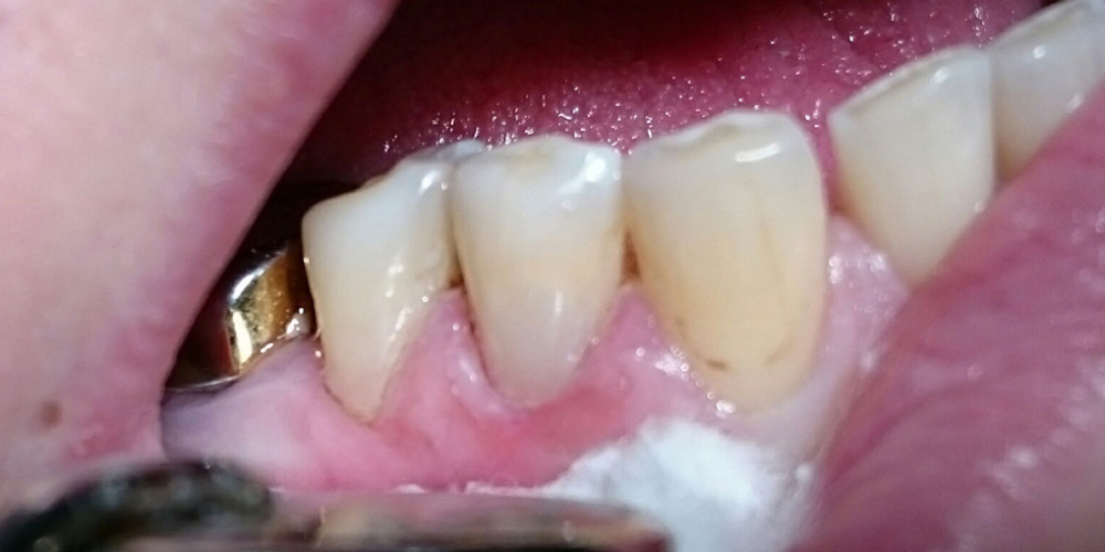 Лечение клиновидного дефекта, восстановление анатомической формы зуба - фото №2
