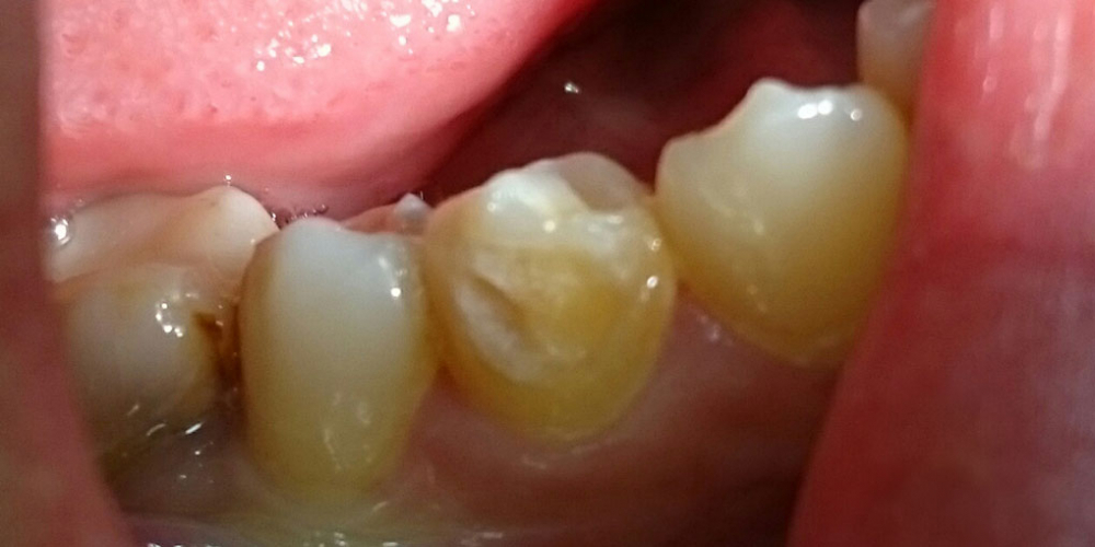 Лечение кариеса зуба 4.4, материал Estelite - фото №1
