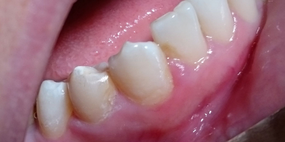 Лечение кариеса зуба 4.4, материал Estelite - фото №2