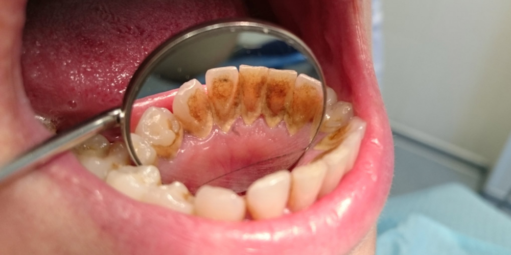 Жалобы на кровоточивость десен при чистке зубов и наличие зубных отложений - фото №1