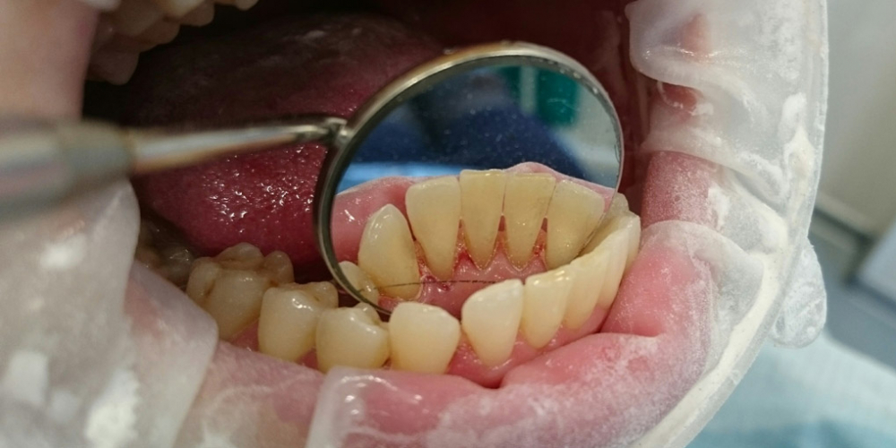 Жалобы на кровоточивость десен при чистке зубов и наличие зубных отложений - фото №2