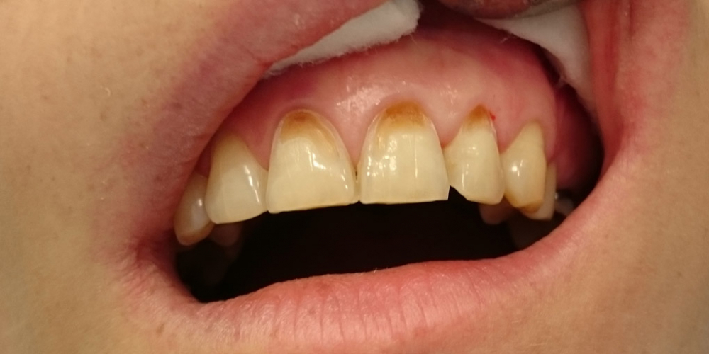 Эстетическое несовершенство трех зубов - фото №1