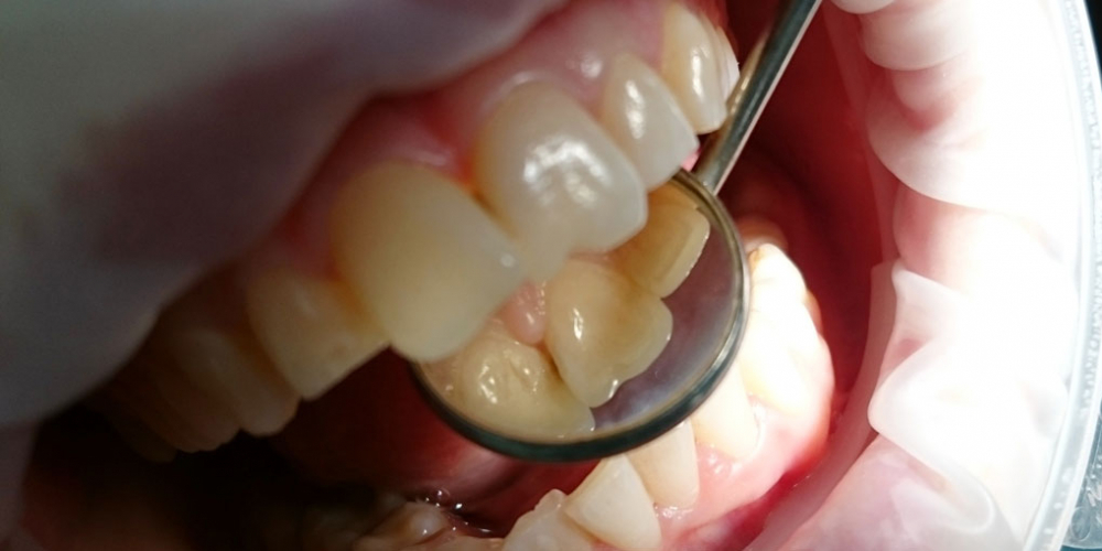 Жалоба на эстетическое несовершенство 2.1 зуба и потемнение между 1.1 и 2.1 зубами - фото №1