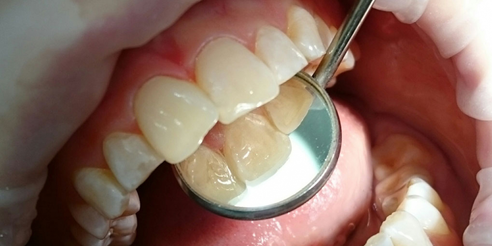 Жалоба на эстетическое несовершенство 2.1 зуба и потемнение между 1.1 и 2.1 зубами - фото №2