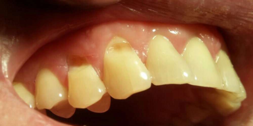 Лечение клиновидного дефекта зубов 1.3, 1.4 - фото №1