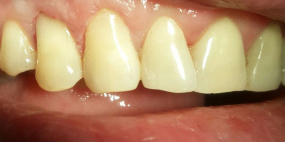 Лечение клиновидного дефекта зубов 1.3, 1.4 - фото №2