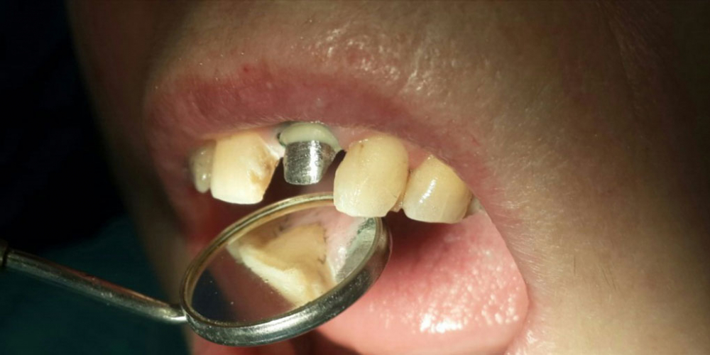 Жалоба на скол коронковой части переднего зуба в результате травмы - фото №1