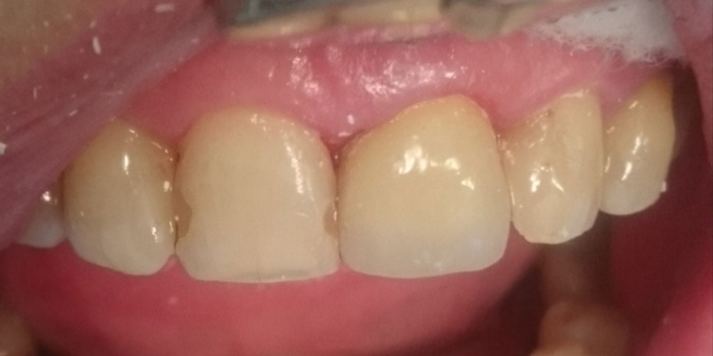 Жалоба на скол коронковой части переднего зуба в результате травмы - фото №2