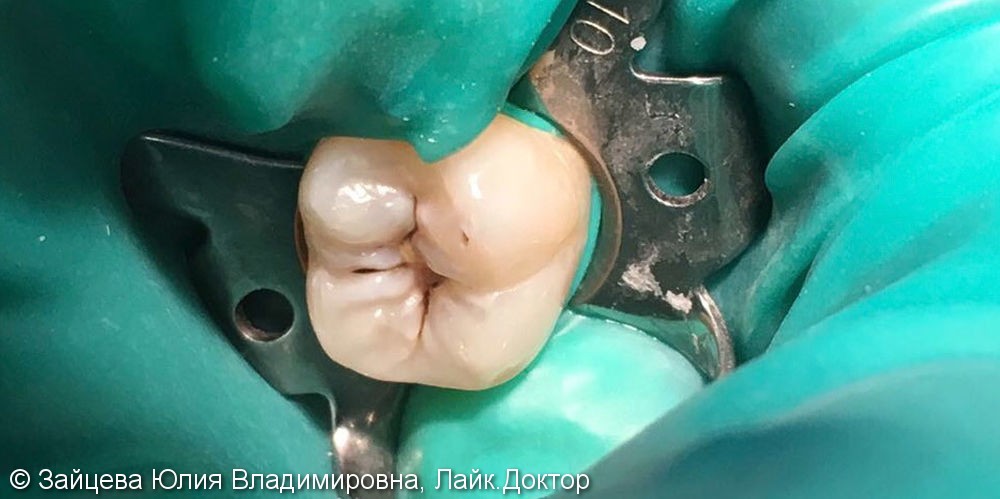 Лечение кариеса в зубе 2.7, результат до и после - фото №1