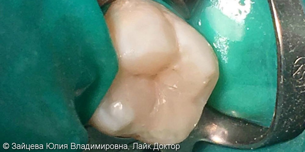 Лечение кариеса в зубе 2.7, результат до и после - фото №2