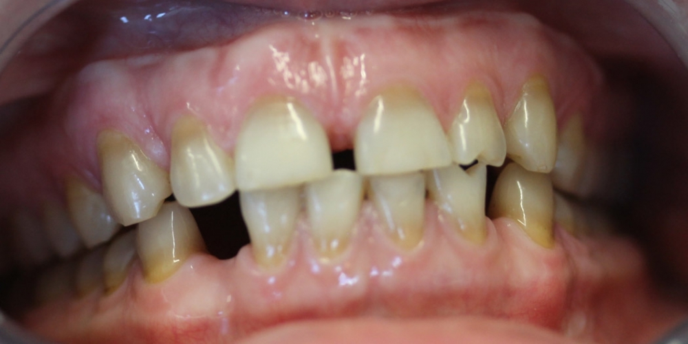 Результат отбеливание зубов системой Zoom - фото №1