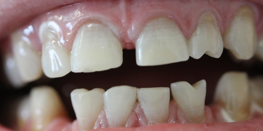 Результат отбеливание зубов системой Zoom - фото №2