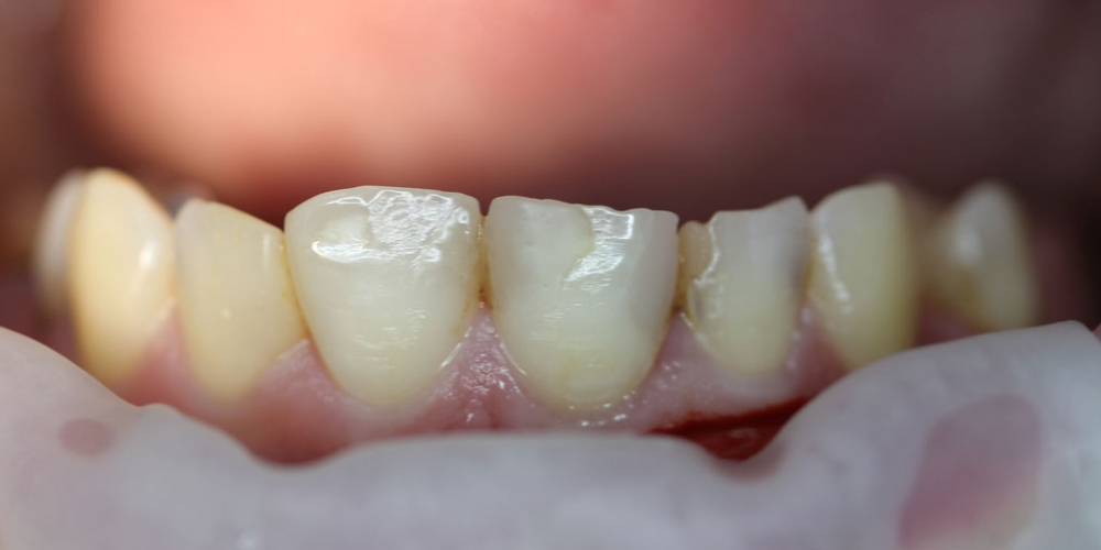 Результат лечения среднего кариеса зуба 1.1 - фото №1