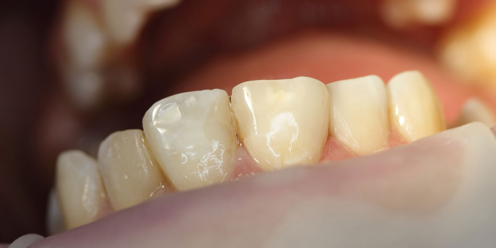 Результат лечения среднего кариеса зуба 1.1 - фото №3