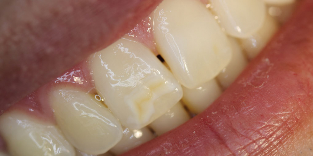 Результат лечения косметического дефекта коронки зуба 1.1 - фото №1