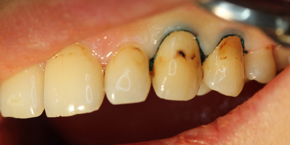 Результат лечения среднего кариеса двух зубов за один прием - фото №1