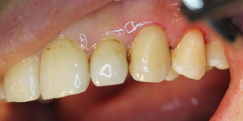 Результат лечения среднего кариеса двух зубов за один прием - фото №2