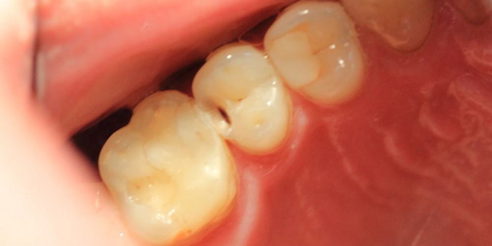 Результат лечения глубокого кариеса зуба 1.5 - фото №1