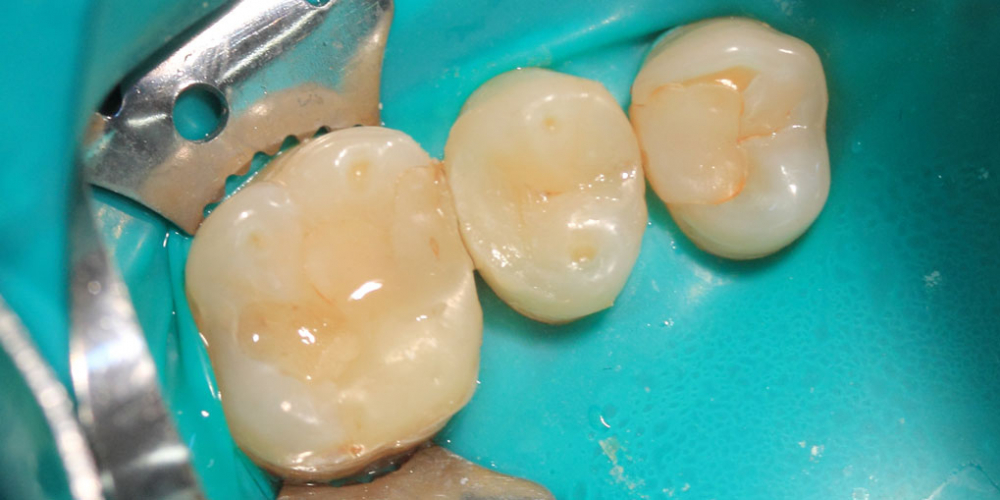 Результат лечения глубокого кариеса зуба 1.5 - фото №2