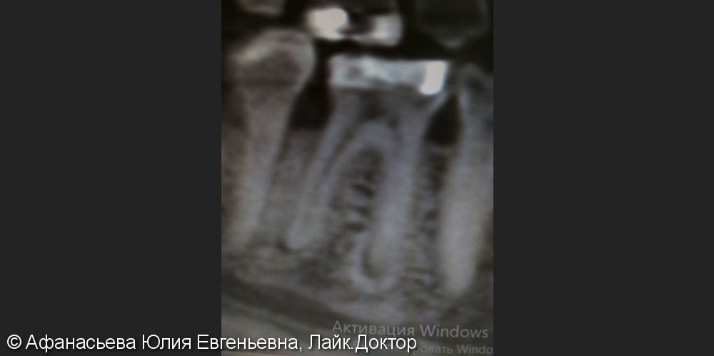 Эндодонтическое лечение зуба в два посещения, до и после - фото №1