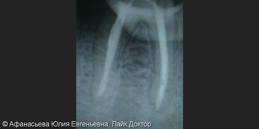 Эндодонтическое лечение зуба в два посещения, до и после - фото №3