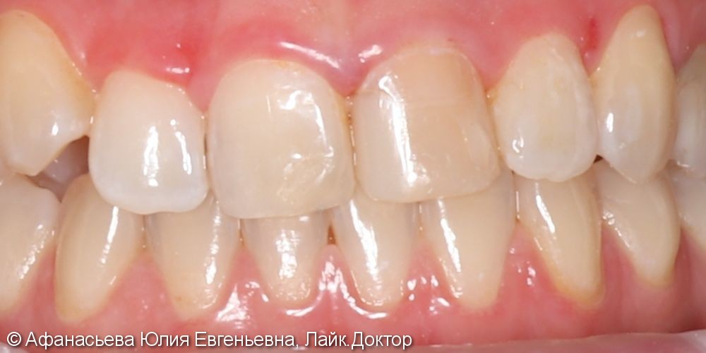 Дисколорит 21 зуба, результат после лечения - фото №1