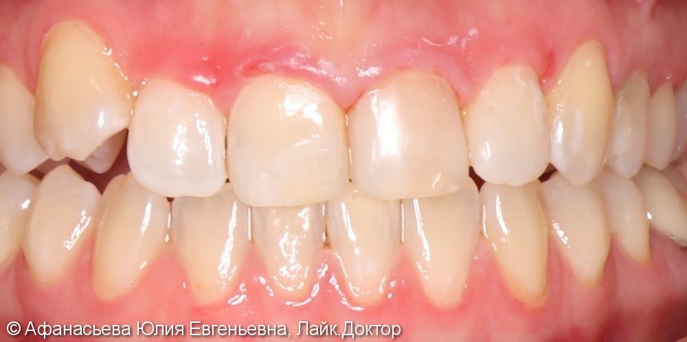 Дисколорит 21 зуба, результат после лечения - фото №2