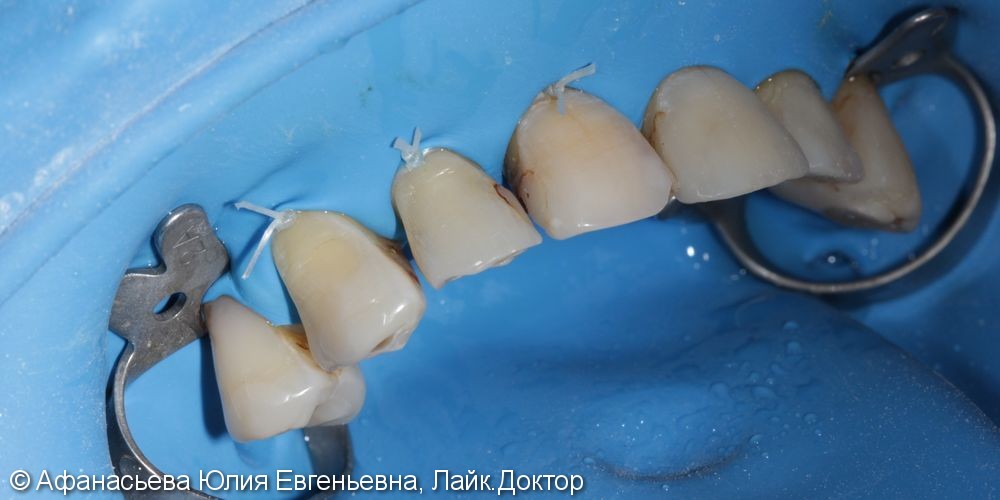 Реставрации зубов с использованием современных светоотверждаемых материалов - фото №1