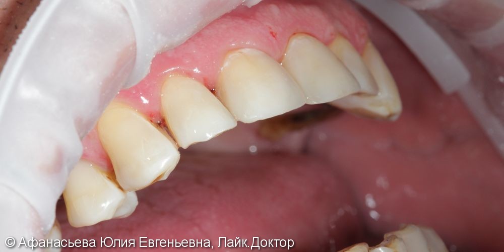 Реставрации зубов с использованием современных светоотверждаемых материалов - фото №2