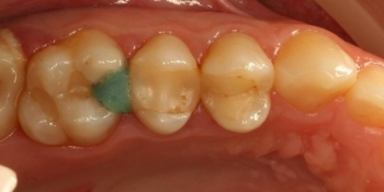 Прямая реставрация жевательного зуба верхней челюсти - фото №1