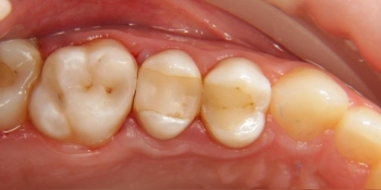 Прямая реставрация жевательного зуба верхней челюсти - фото №5