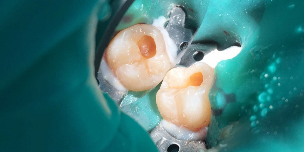 В зубе 47 была выявлена скрытая кариозная полость - фото №1