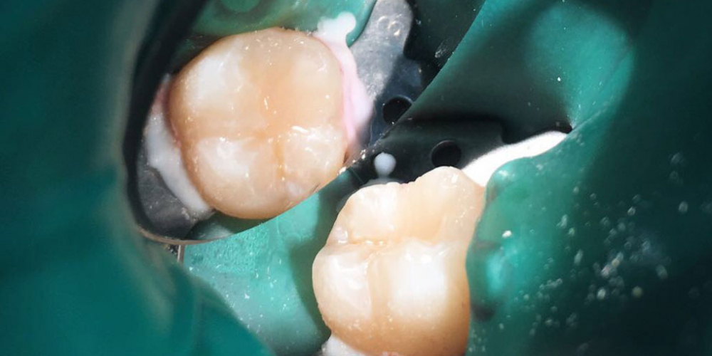 В зубе 47 была выявлена скрытая кариозная полость - фото №2