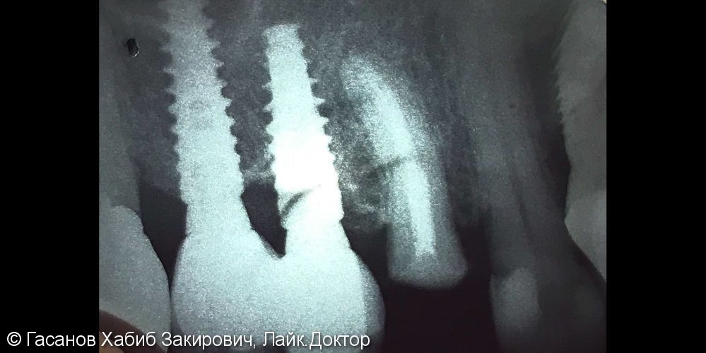 Повторное эндодонтическое лечение зуба 24, рядом с имплантатом - фото №3