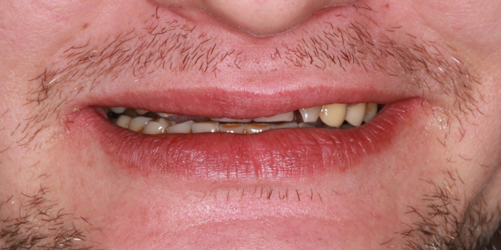 Восстановление зубов коронками из диоксида циркония - фото №1
