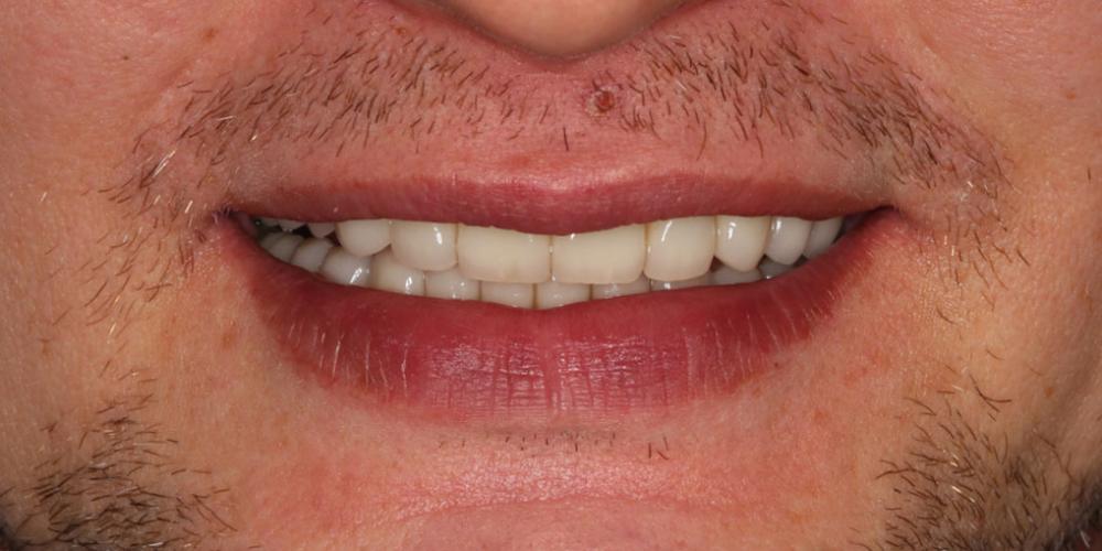 Восстановление зубов коронками из диоксида циркония - фото №4