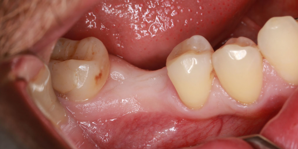 Восстановление жевательного зуба имплантатом Osstem + коронка - фото №1
