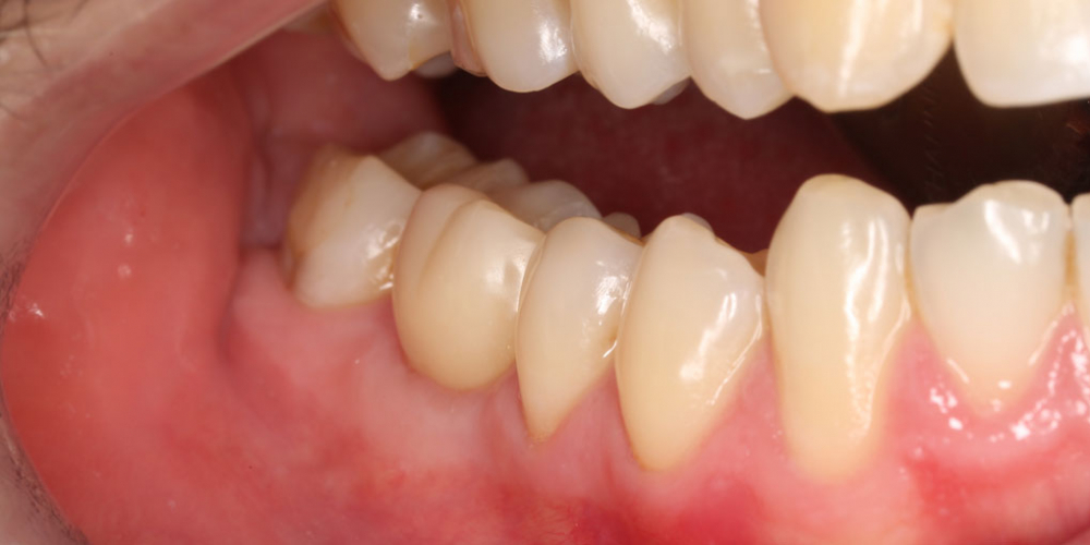 Восстановление жевательного зуба имплантатом Osstem + коронка - фото №4