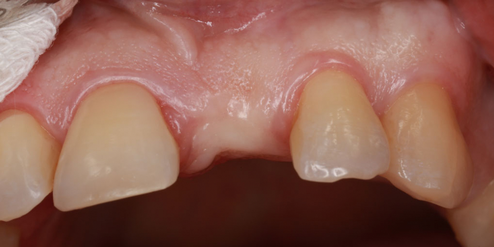 Восстановление зуба с помощью вживления имплантата и коронки - фото №1