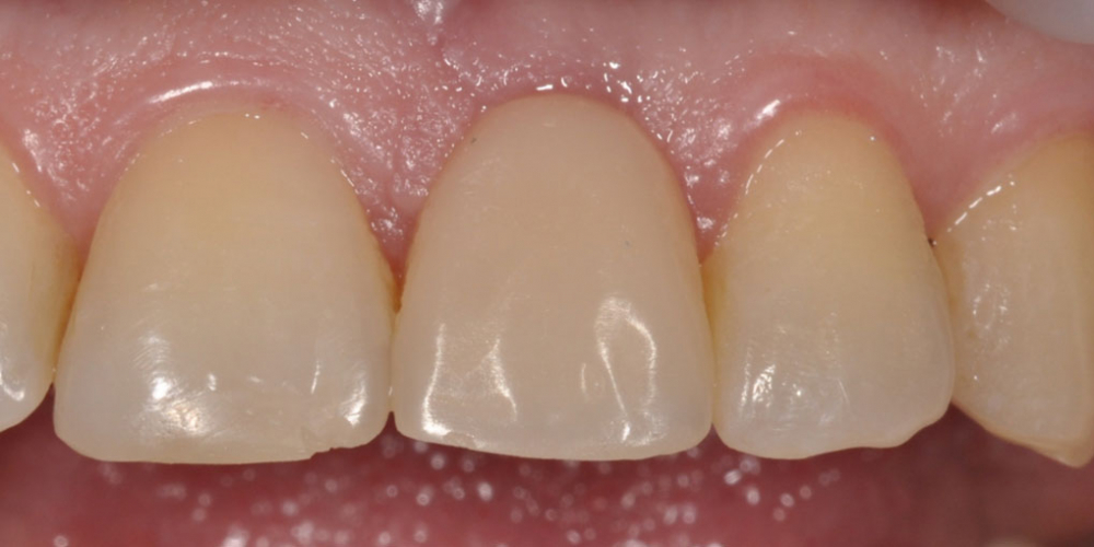 Восстановление зуба с помощью вживления имплантата и коронки - фото №3
