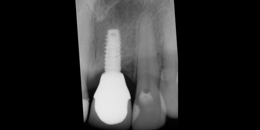 Восстановление зуба с помощью вживления имплантата и коронки - фото №2