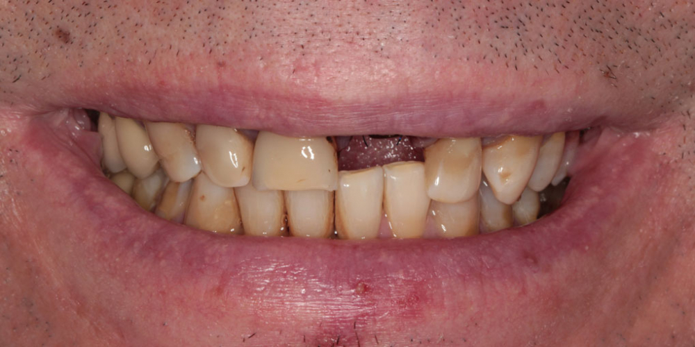 Восстановление передних зубов верхней челюсти - фото №1