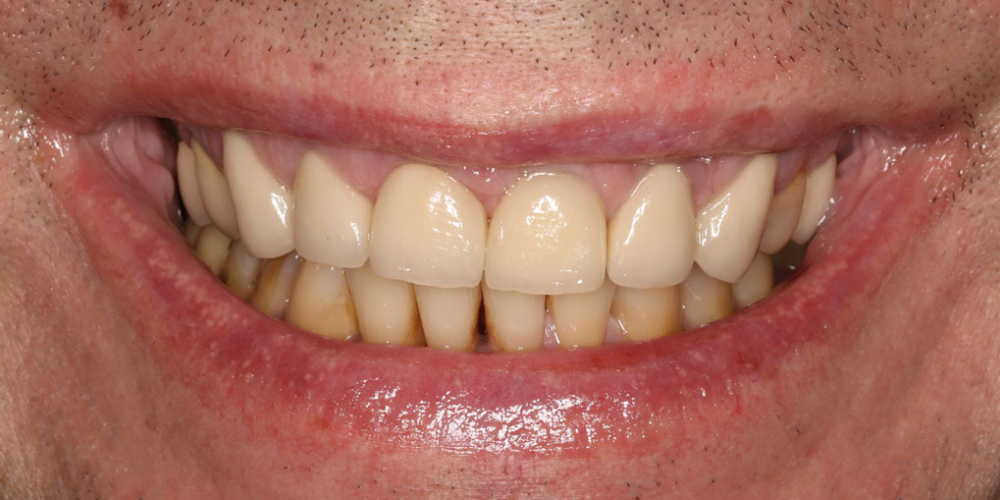Восстановление передних зубов верхней челюсти - фото №4