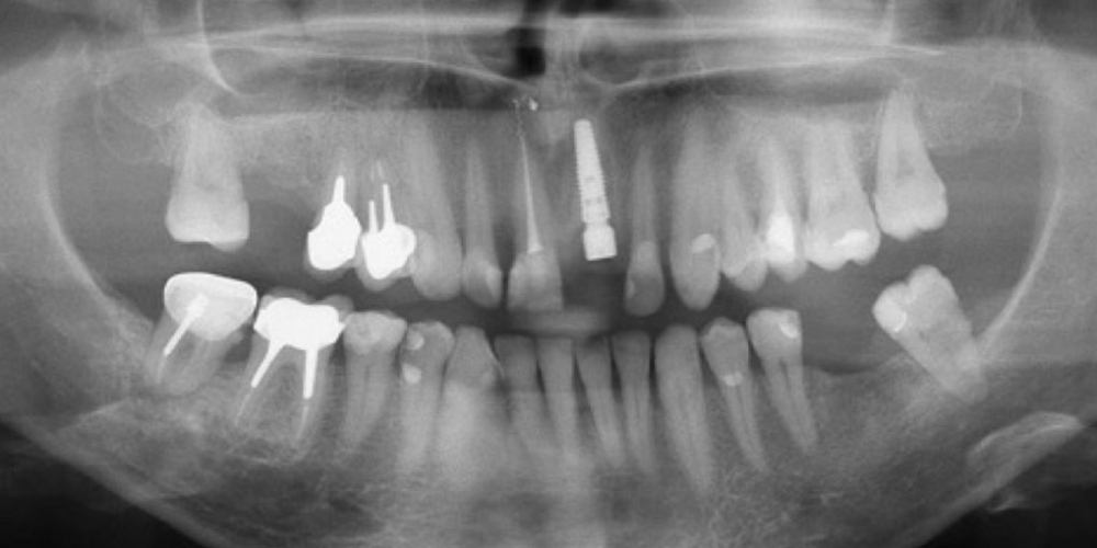 Восстановление передних зубов верхней челюсти - фото №3