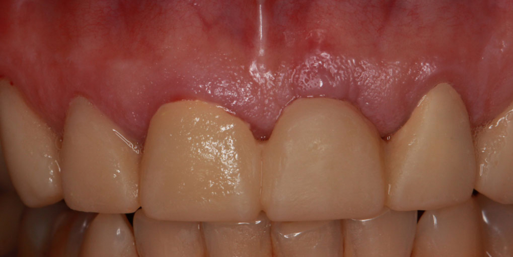 Восстановление передних зубов верхней челюсти - фото №2