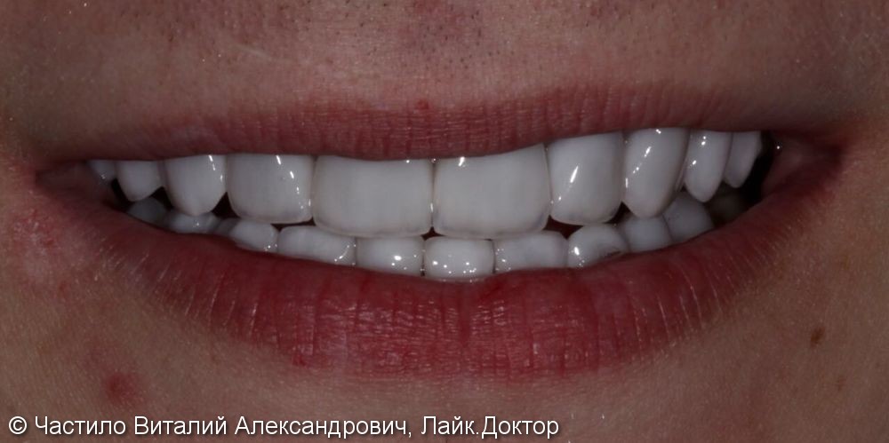 Керамические виниры на зубы, цвет Блич 2 - фото №2