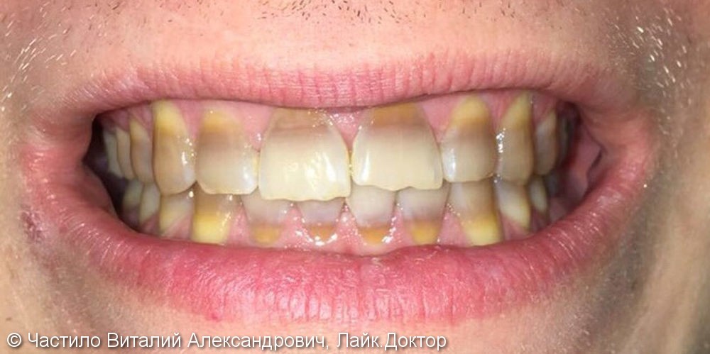 Керамические виниры на зубы, цвет Блич 2 - фото №1