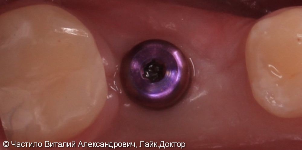 Протезирование на импланте Nobel, коронка из диоксида циркония - фото №2